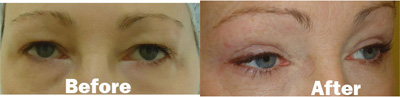 VITA SURGICAL EYELID MICROSURGERY BEFORE AFTER PHOTO
