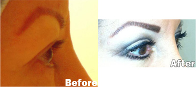 VITA SURGICAL EYELID MICROSURGERY BEFORE AFTER PHOTO