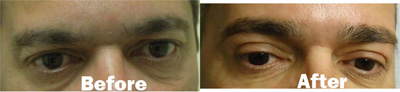 VITA SURGICAL EYELID MICROSURGERY BEFORE AFTER PHOTO