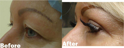 VITA SURGICAL EYELID MICROSURGERY BEFORE AFTER PHOTO
