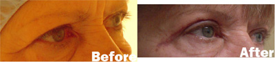 VITA SURGICAL EYELID MICROSURGERY BEFORE AFTER PHOTO