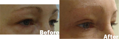 VITA SURGICAL EYELID MICROSURGERY BEFORE AFTER PHOTO