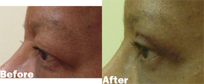 VITA SURGICAL EYELID MICROSURGERY BEFORE AFTER PHOTO