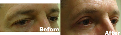 VITA SURGICAL EYELID MICROSURGERY BEFORE AFTER PHOTO