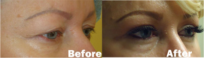 VITA SURGICAL EYELID MICROSURGERY BEFORE AFTER PHOTO