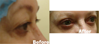 VITA SURGICAL EYELID MICROSURGERY BEFORE AFTER PHOTO