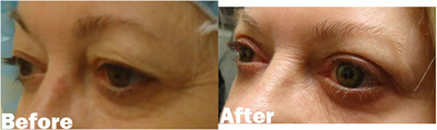 VITA SURGICAL EYELID MICROSURGERY BEFORE AFTER PHOTO