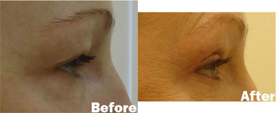 VITA SURGICAL EYELID MICROSURGERY BEFORE AFTER PHOTO