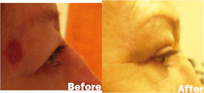 VITA SURGICAL EYELID MICROSURGERY BEFORE AFTER PHOTO