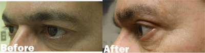 VITA SURGICAL EYELID MICROSURGERY BEFORE AFTER PHOTO
