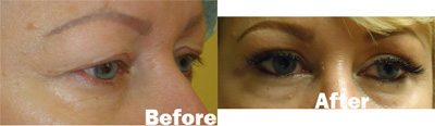 VITA SURGICAL EYELID MICROSURGERY BEFORE AFTER PHOTO