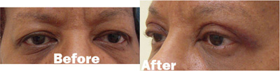 VITA SURGICAL EYELID MICROSURGERY BEFORE AFTER PHOTO