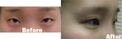 VITA SURGICAL EYELID MICROSURGERY BEFORE AFTER PHOTO