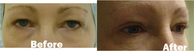 VITA SURGICAL EYELID MICROSURGERY BEFORE AFTER PHOTO