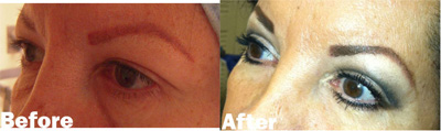 VITA SURGICAL EYELID MICROSURGERY BEFORE AFTER PHOTO