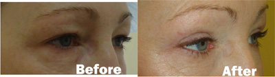 VITA SURGICAL EYELID MICROSURGERY BEFORE AFTER PHOTO