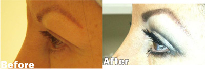 VITA SURGICAL EYELID MICROSURGERY BEFORE AFTER PHOTO
