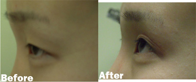 VITA SURGICAL EYELID MICROSURGERY BEFORE AFTER PHOTO