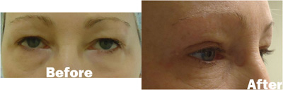VITA SURGICAL EYELID MICROSURGERY BEFORE AFTER PHOTO