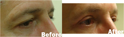 VITA SURGICAL EYELID MICROSURGERY BEFORE AFTER PHOTO