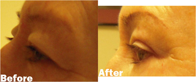 VITA SURGICAL EYELID MICROSURGERY BEFORE AFTER PHOTO
