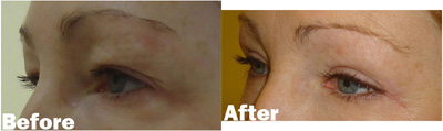VITA SURGICAL EYELID MICROSURGERY BEFORE AFTER PHOTO