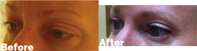 VITA SURGICAL EYELID MICROSURGERY BEFORE AFTER PHOTO