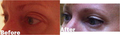VITA SURGICAL EYELID MICROSURGERY BEFORE AFTER PHOTO