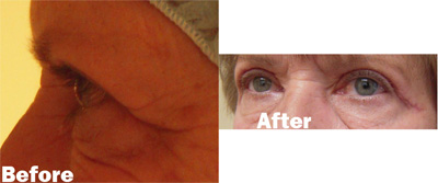 VITA SURGICAL EYELID MICROSURGERY BEFORE AFTER PHOTO
