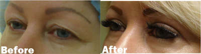 VITA SURGICAL EYELID MICROSURGERY BEFORE AFTER PHOTO
