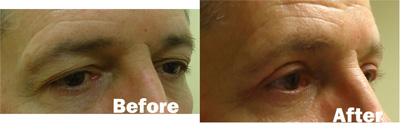 VITA SURGICAL EYELID MICROSURGERY BEFORE AFTER PHOTO