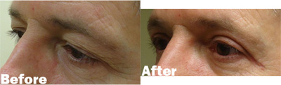 VITA SURGICAL EYELID MICROSURGERY BEFORE AFTER PHOTO