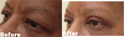 VITA SURGICAL EYELID MICROSURGERY BEFORE AFTER PHOTO