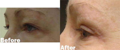 VITA SURGICAL EYELID MICROSURGERY BEFORE AFTER PHOTO