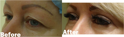 VITA SURGICAL EYELID MICROSURGERY BEFORE AFTER PHOTO