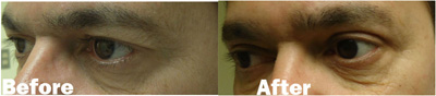 VITA SURGICAL EYELID MICROSURGERY BEFORE AFTER PHOTO