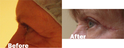 VITA SURGICAL EYELID MICROSURGERY BEFORE AFTER PHOTO
