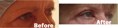 VITA SURGICAL EYELID MICROSURGERY BEFORE AFTER PHOTO