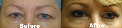 VITA SURGICAL EYELID MICROSURGERY BEFORE AFTER PHOTO