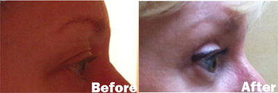VITA SURGICAL EYELID MICROSURGERY BEFORE AFTER PHOTO
