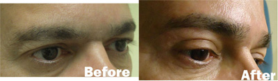 VITA SURGICAL EYELID MICROSURGERY BEFORE AFTER PHOTO