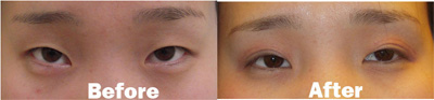 VITA SURGICAL EYELID MICROSURGERY BEFORE AFTER PHOTO