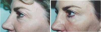 VITA SURGICAL BOTOX  BEFORE AFTER PHOTO