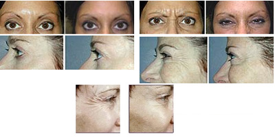 VITA SURGICAL BOTOX  BEFORE AFTER PHOTO