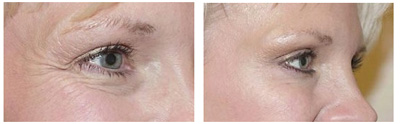 VITA SURGICAL BOTOX  BEFORE AFTER PHOTO