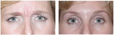 VITA SURGICAL BOTOX  BEFORE AFTER PHOTO