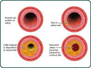 Illustration of plaque build-up in an artery.